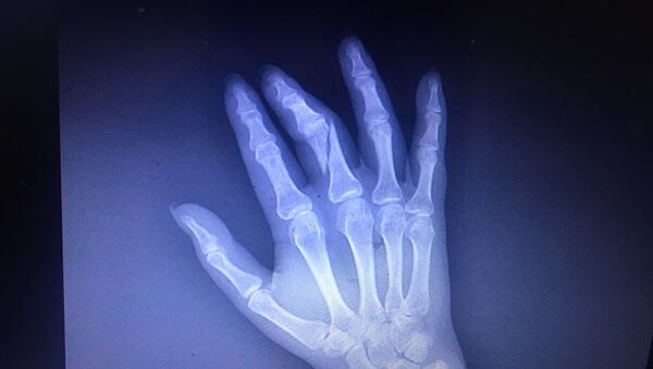 در ایران پس از ضرب و شتم خبرنگار، انگشت دست او را شکستند+عکس - اسپوتنیک ایران  