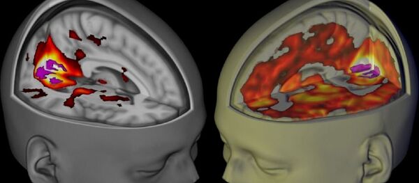 Handout shows the brains of subjects lying awake with their eyes closed, under a placebo and the drug LSD, when being examined using functional MRI. Handout shows the brains of subjects lying awake with their eyes closed, under a placebo and the drug LSD, when being examined using functional MRI. - اسپوتنیک ایران