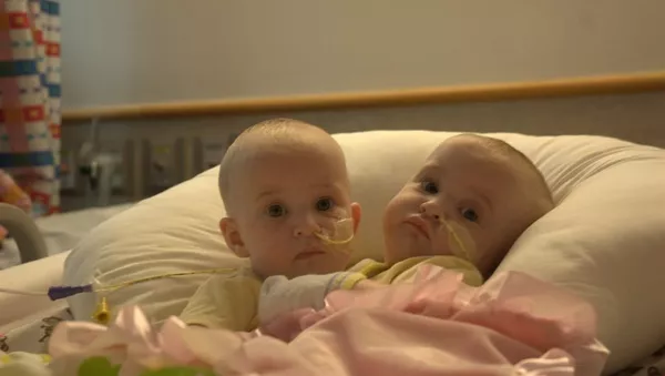 Conjoined Twins - اسپوتنیک ایران  