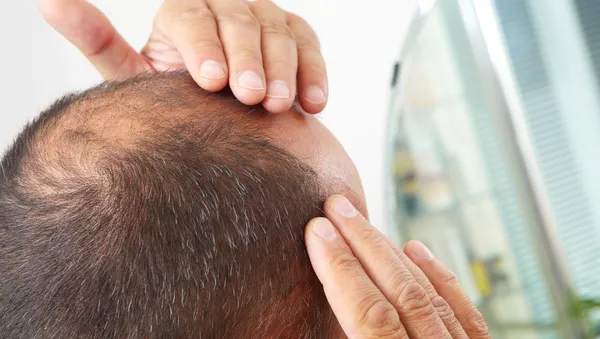 چرا موهای ما می ریزد؟ - اسپوتنیک ایران  