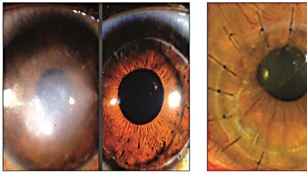 روش درمان سوختگی قرنیه چشم با استفاده از سلول‌های بنیادی - اسپوتنیک ایران  