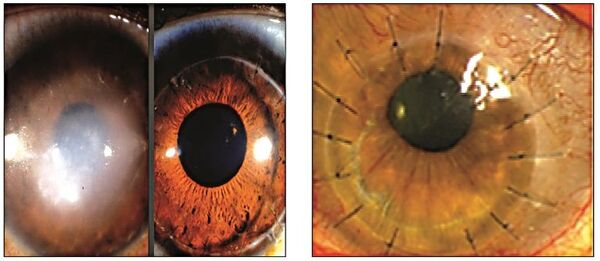 روش درمان سوختگی قرنیه چشم با استفاده از سلولهای بنیادی روش درمان سوختگی قرنیه چشم با استفاده از سلولهای بنیادی - اسپوتنیک ایران