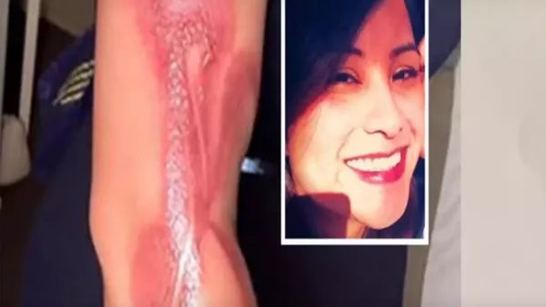 زندگی با زن ورزشکار و مدل پس از سوختگی صورت و بدن +عکس - اسپوتنیک ایران  