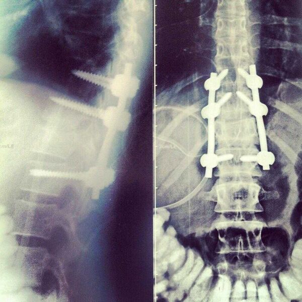 عکس از مهره کمر مونا سراجی عکس از مهره کمر مونا سراجی - اسپوتنیک ایران